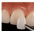 Lentes de contato dental